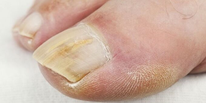 nail fungus symptoms
