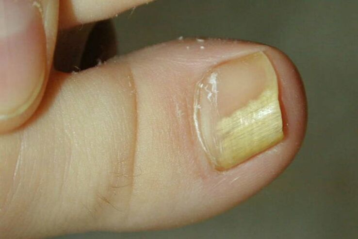 Signs of fungus on the big toe photo 1