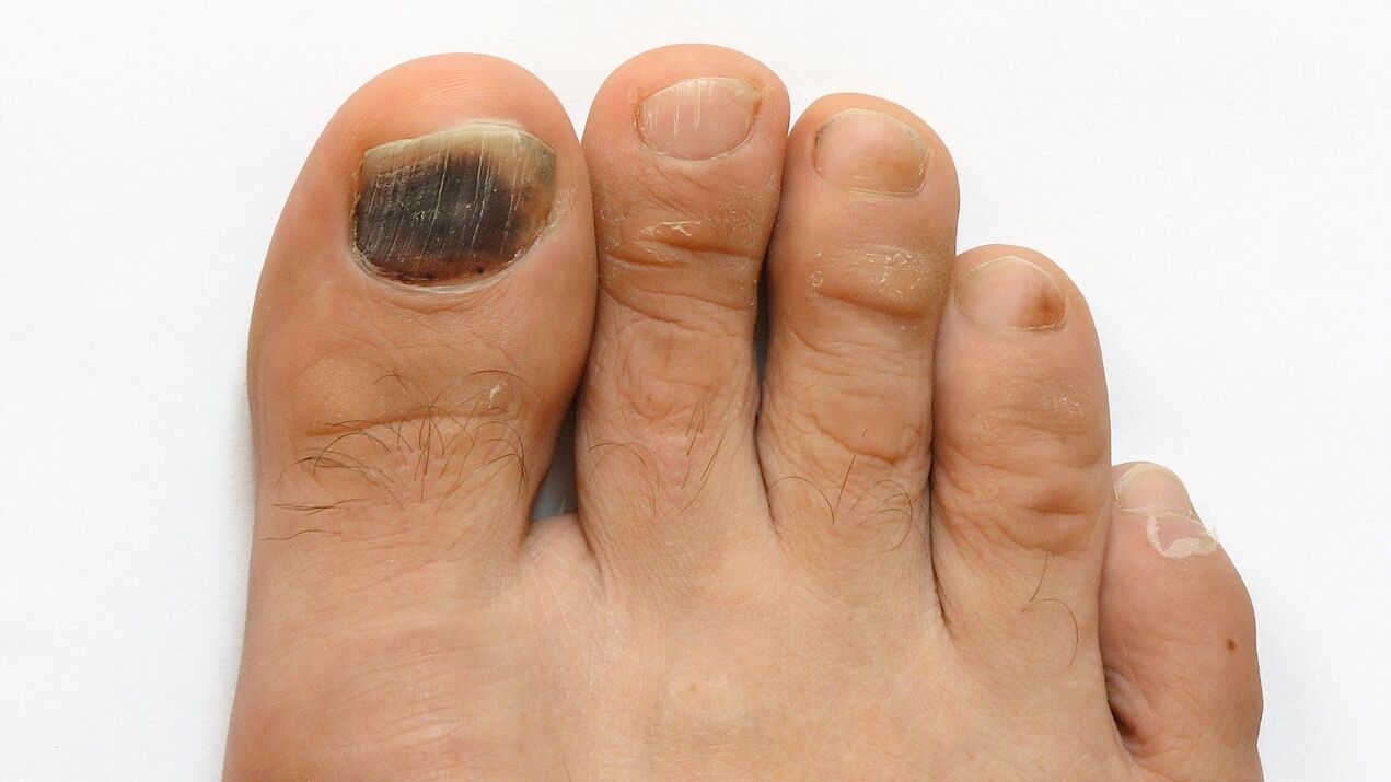 Signs of fungus on the big toe photo 2