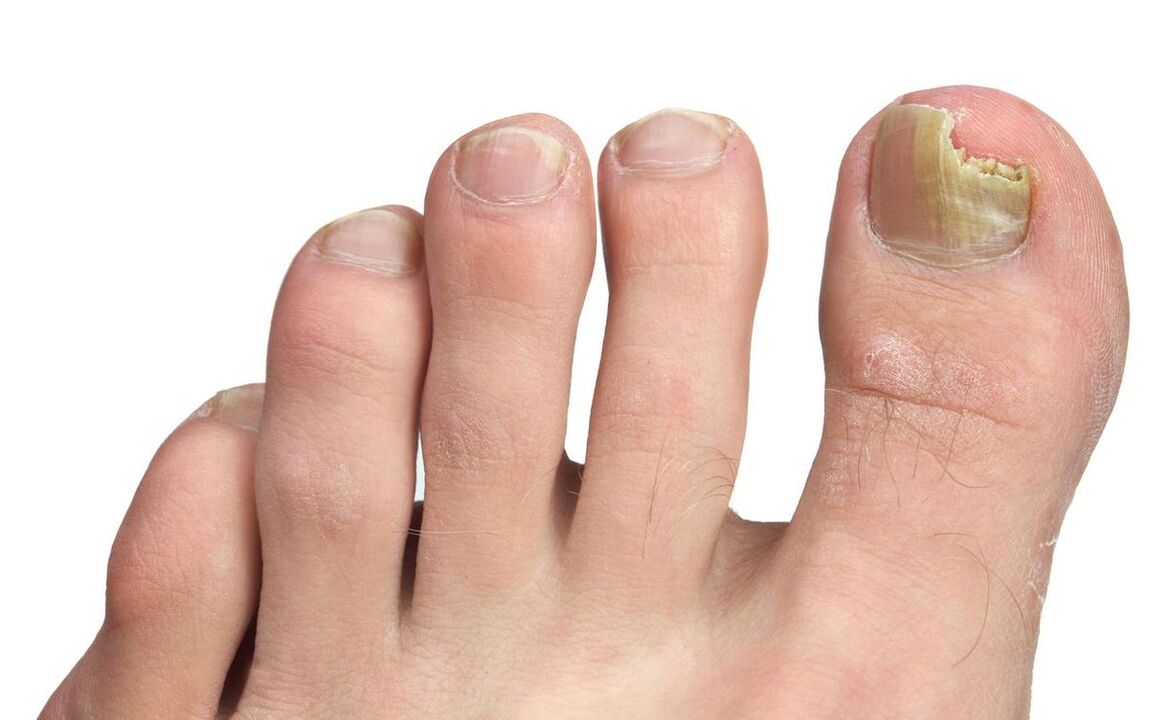 Signs of fungus on the big toe photo 3