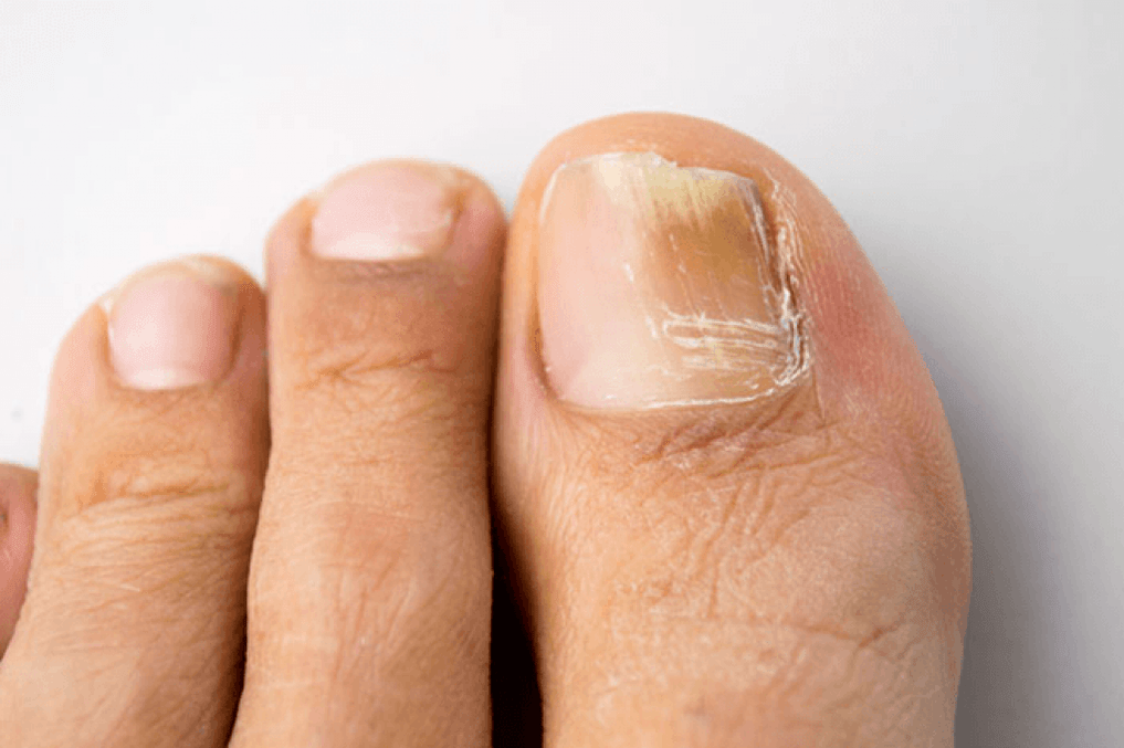 Signs of fungus on the big toe photo 4