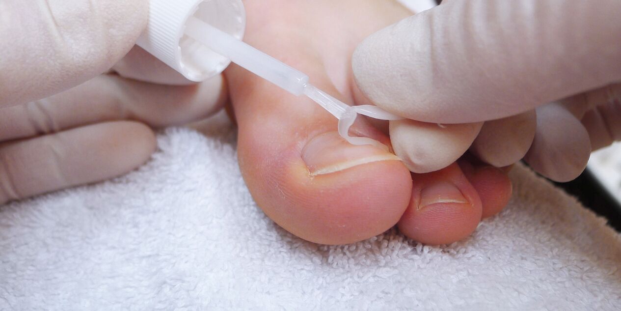 medicated varnish against nail fungus