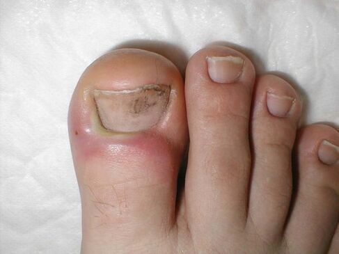 fungal treatment drops on toenails