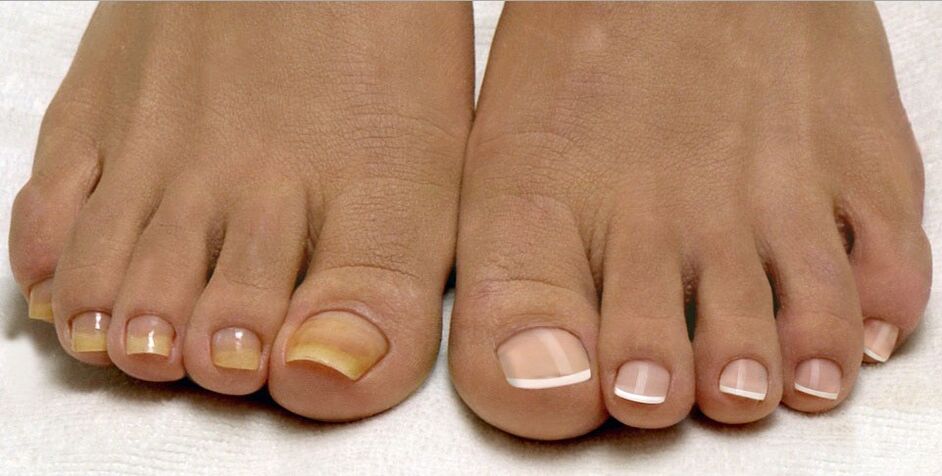 fungus on healthy nails and toenails