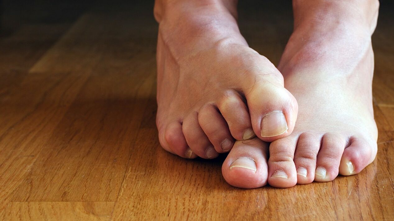 itching of the skin of the feet with fungus