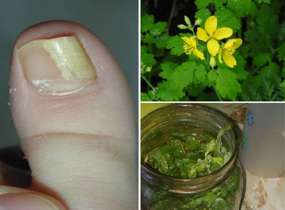 celandine for the treatment of nail fungus
