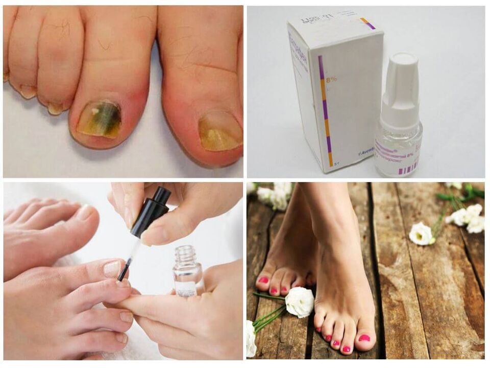 how to use polishes against nail fungus