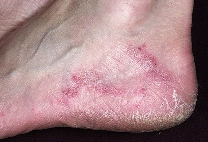 Cracks and redness on the skin of the heels are signs of a fungal infection