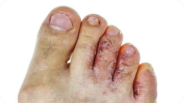 What does athlete's foot look like 