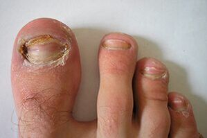 Mushrooms on the nail