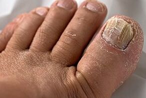 Picture of nail fungi