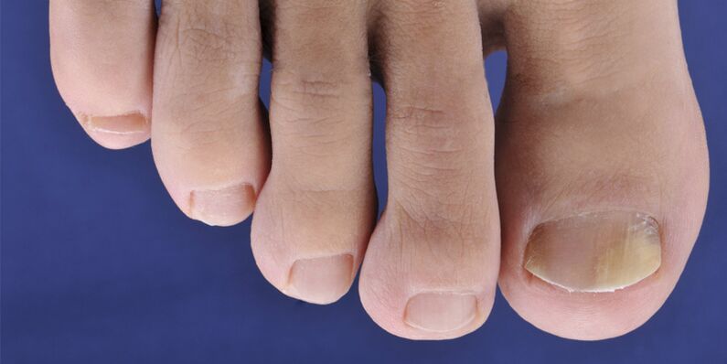 Symptoms of skin michaos and nail plates