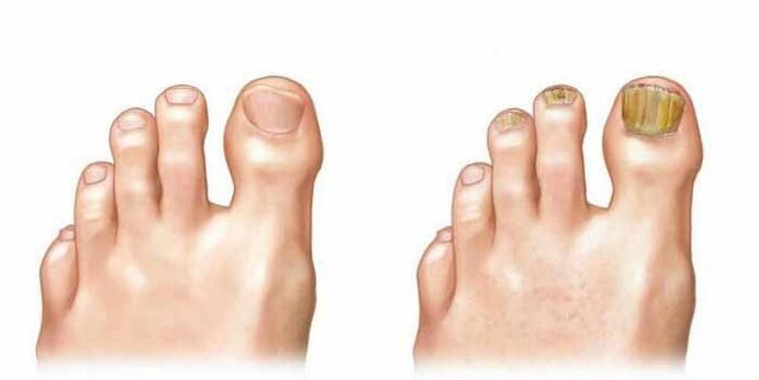 What does fungus look like in nails