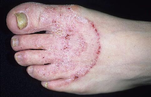 Foot and nail fungus
