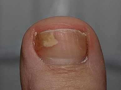 Mushrooms on the left side of the nail