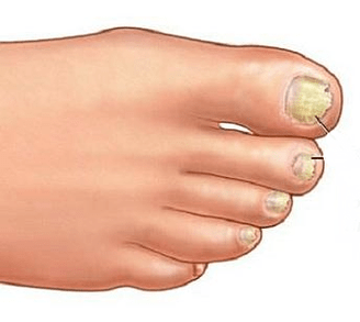 Onyokomycosis