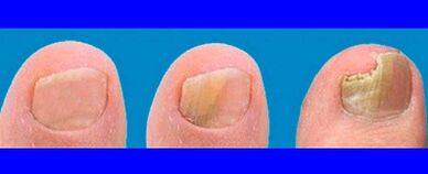 Development stages of the mushroom in the toes