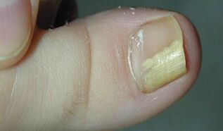 Signs and symptoms of nail fungi