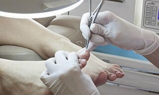 Surgical removal of the nail in the presence of a mushroom