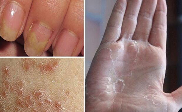 Mikosis can move to other parts of the body
