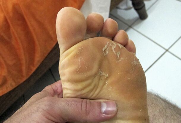 Mushrooms in the legs of the legs