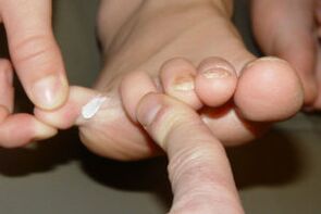 fungus on the toes