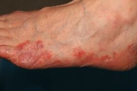 manifestations of fungi on the legs