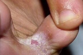 signs of fungus between the toes