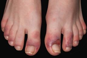 signs of fungus on the toes