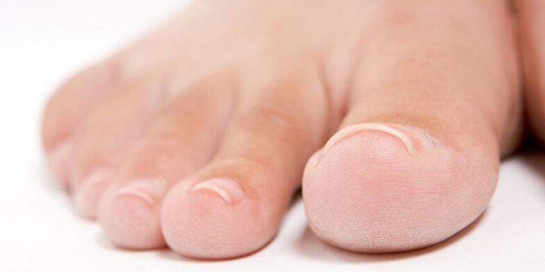 the initial stage of nail fungus