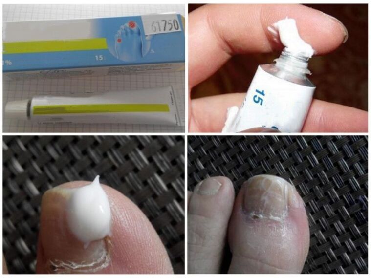 ointments against nail fungus