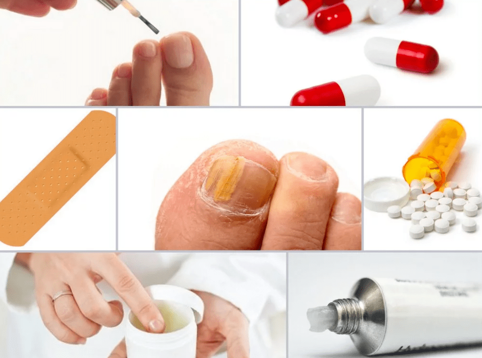 systemic medications for nail fungus