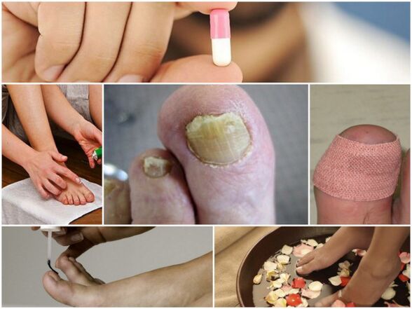 types of treatment of nail fungus
