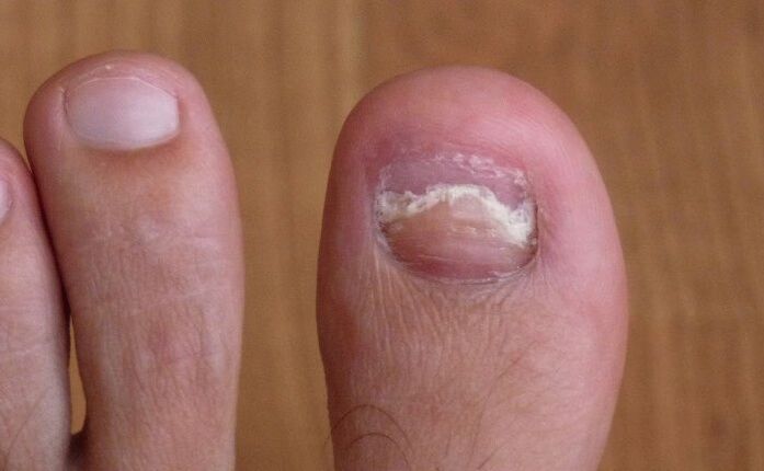 damage to the nail on the thumb with fungus