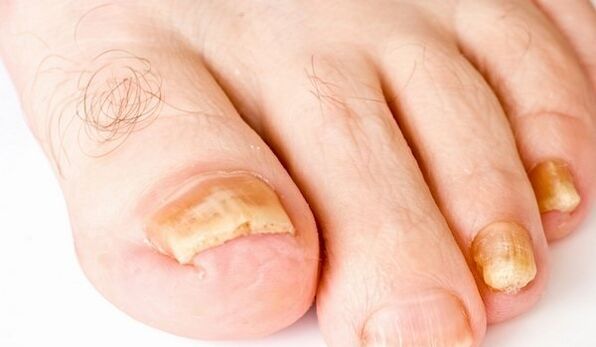 yellow nails for fungal infections